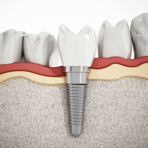Implantologie vonDental-Ästhetik Center Dr. med. dent. Uwe Lucas in Schüttorf
