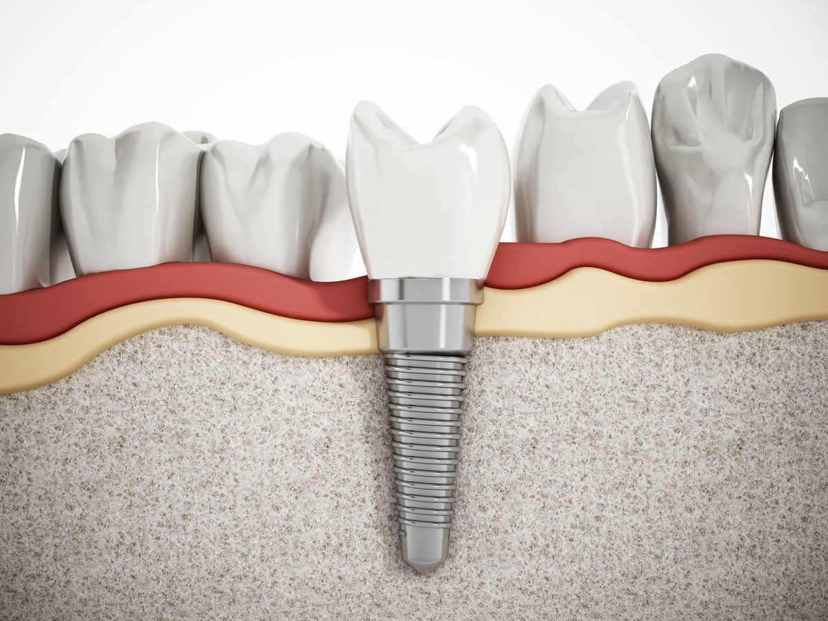 Implantologie vonDental-Ästhetik Center Dr. med. dent. Uwe Lucas in Schüttorf
