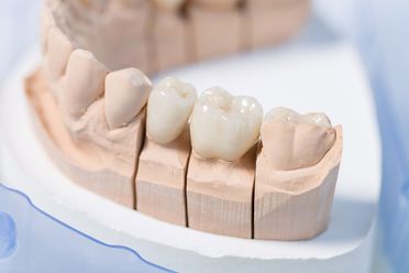 Cerec 3 D von Dental-Ästhetik Center Dr. med. dent. Uwe Lucas in Schüttorf